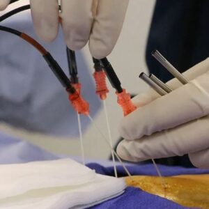 13 yillik bel fitigindan tek bir islemle kurtuldu bir haftada normal hayatina dondu 8FLE9PK5