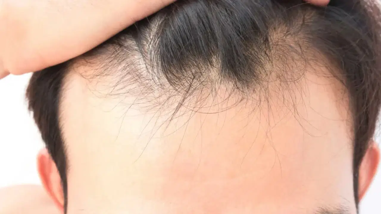 sac dokulmesinde gizli neden vitamin ve mineral eksikligi ne kadar etkili SDbywevu.jpg